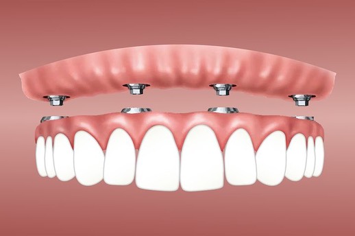 overdenture-3597628__480